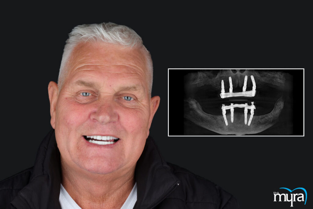 All On 4 diş implantı, All-on-4 İmplant :Tüm Ağız İmplant Tedavisi