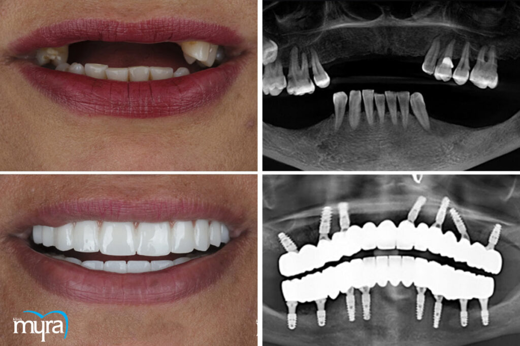 All On 4 diş implantı, All-on-4 İmplant :Tüm Ağız İmplant Tedavisi