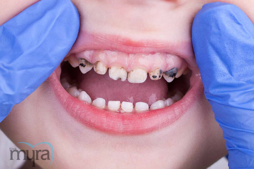 , Çocuk Diş Tedavisinde Ampütasyon Nedir?