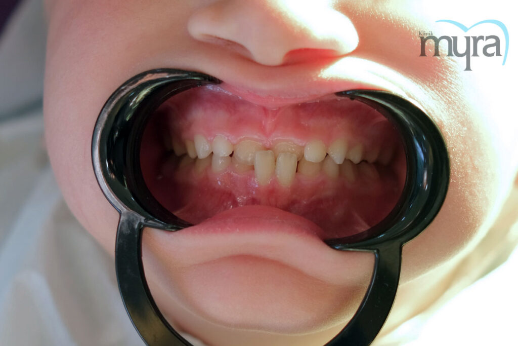 , Çocuklarda Ortodonti Tedavisi