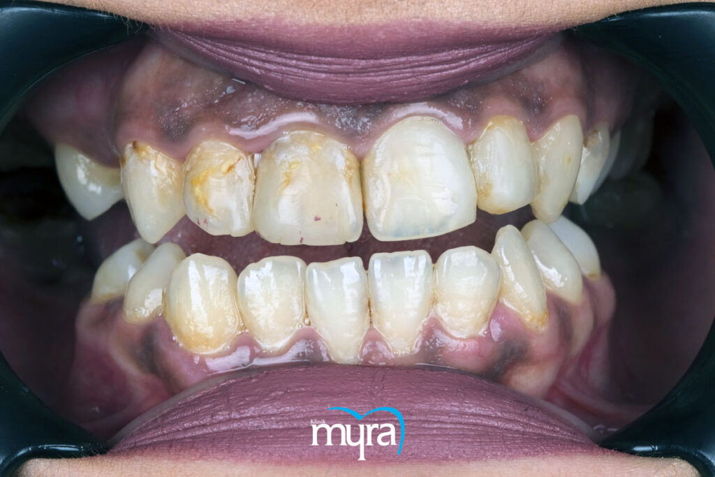 gummy smile, Gülerken Diş Etinin Fazla Görünmesi : Gummy Smile Nedir?