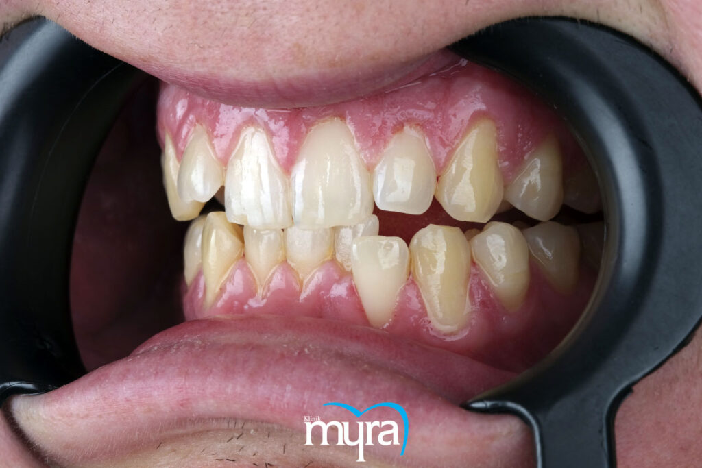 gummy smile, Gülerken Diş Etinin Fazla Görünmesi : Gummy Smile Nedir?